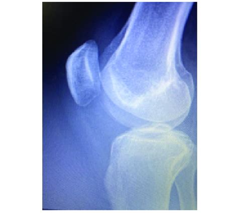 Conventional Lateral Radiograph Of The Knee Demonstrates No Bony