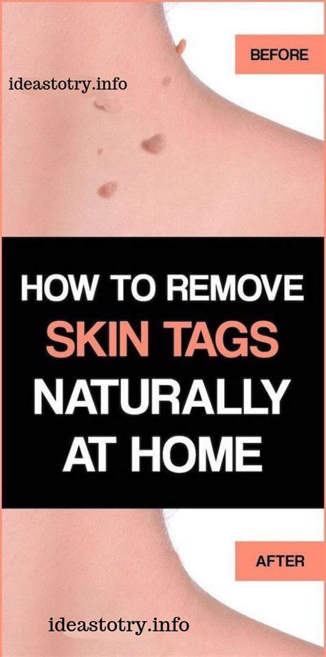 how to remove skin tags naturally at home top 10 tips purchase a lot more spectacular wall