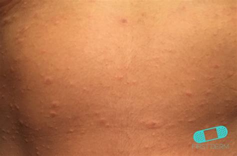Pityriasis versicolor is a common yeast infection of the skin, in which flaky discoloured patches appear on the chest and back. Online Dermatology - Pityriasis Rosea