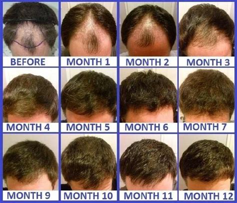 Hair Transplant Growth Stages