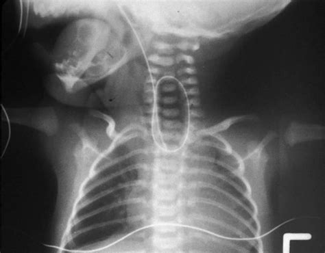 Transesophageal Fistula Pediatrics Medbullets Step 2 3