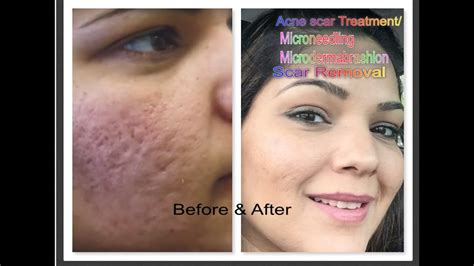 Part 1 Acne Scar Treatment Micro Needling Microdermabrasion Pimples