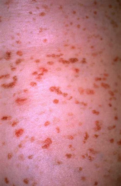 Keratosis Lichenoides Chronica Report Of A New Case With Success Of