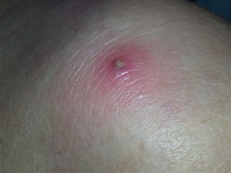 I Had Mrsa A Type Of Staph Infection Think Its Coming Back Popping