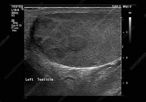 Testicular Cancer Ultrasound Scan Stock Image C Science Photo Library