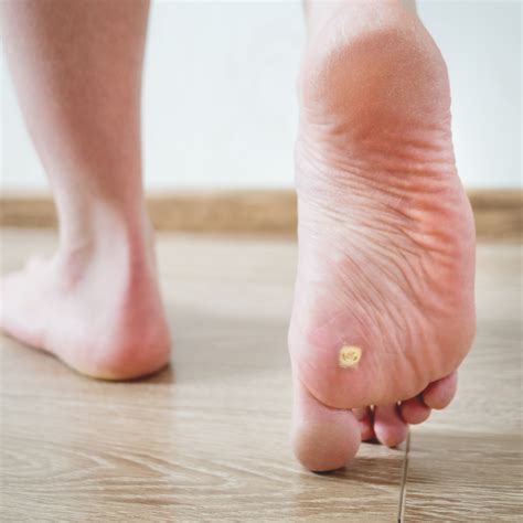 Best Podiatrist In Bethpage Ny What Are Plantar Warts