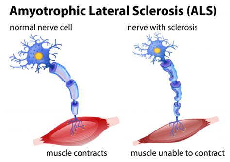 Amyotrophic Lateral Sclerosis Treatment In Thailand Almurshidi