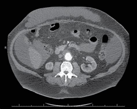 Enhanced Computed Tomography Scan Of The Abdomen Three Weeks