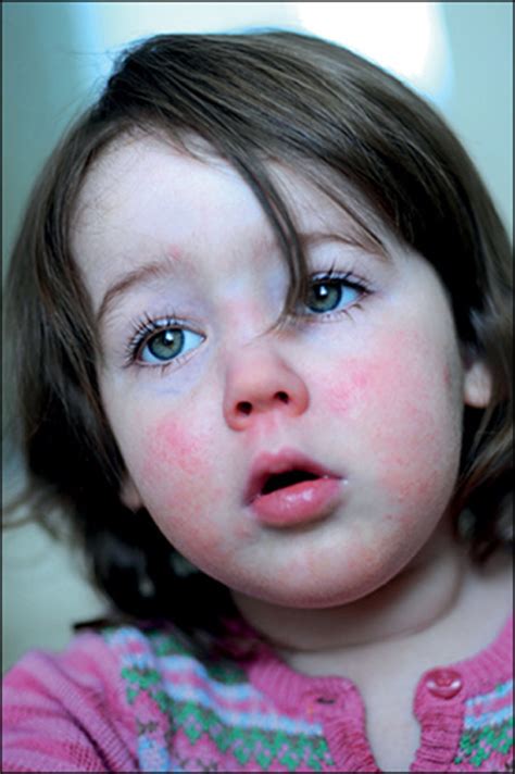 Scarlet Fever Makes A Comeback The Lancet Infectious Diseases