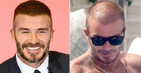 Top Famous Celebrity Hair Transplants Before And After