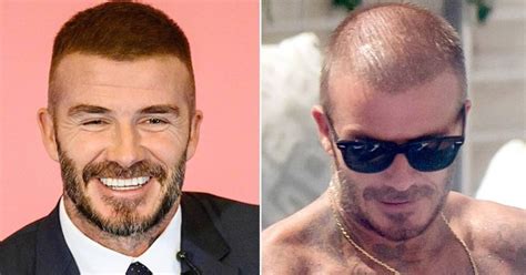 Top 20 Famous Celebrity Hair Transplants Before And After