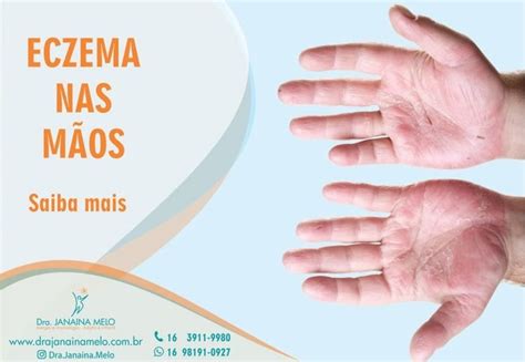 Eczema Nas MÃos Saiba Mais Dra Janaina Melo Instituto De