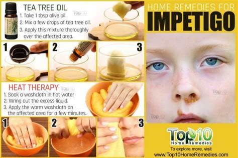 Impetigo Home Remedies Prevention And When To See A Doctor Top 10