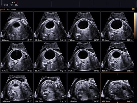 Ultrasound Images • Fetus Abdominal Cyst Msv Echogramm №513