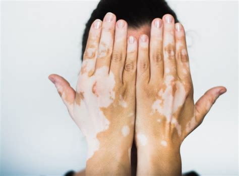 Vitiligo Treatment In Ghaziabad And Delhi White Patches Akiya Aesthetics