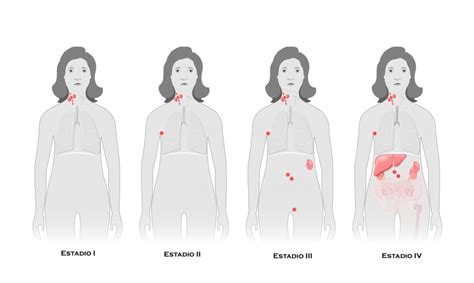 Deverá estar atento e consultar o seu médico se tiver os seguintes sintomas: Estadiamento do linfoma determina o tratamento - Revista Online ABRALE