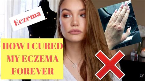 How I Cured My Eczema Forever Youtube