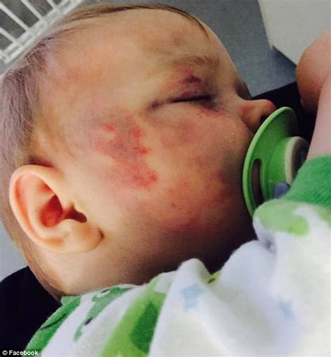 Father Of Baby Who Was Bashed By Mother Speaks Of Injuries Daily Mail
