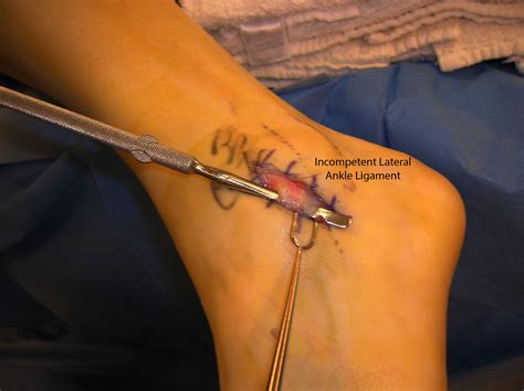 Lateral Ankle Ligament Reconstruction Ankle Ligaments Ankle Surgery Torn Ligament In Ankle