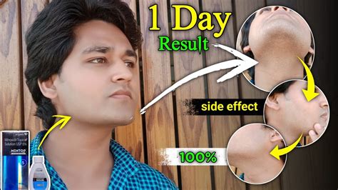 Minoxidil 1 Day Beard Growth After Clean Shave Minoxidil Beard Result