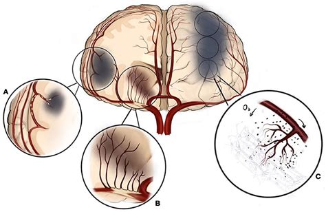 Frontiers Endovascular Treatment Of Intracranial Atherosclerotic