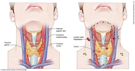 Thyroid Cancer Stages Cancernet