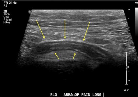 Appendicitis Stepwards