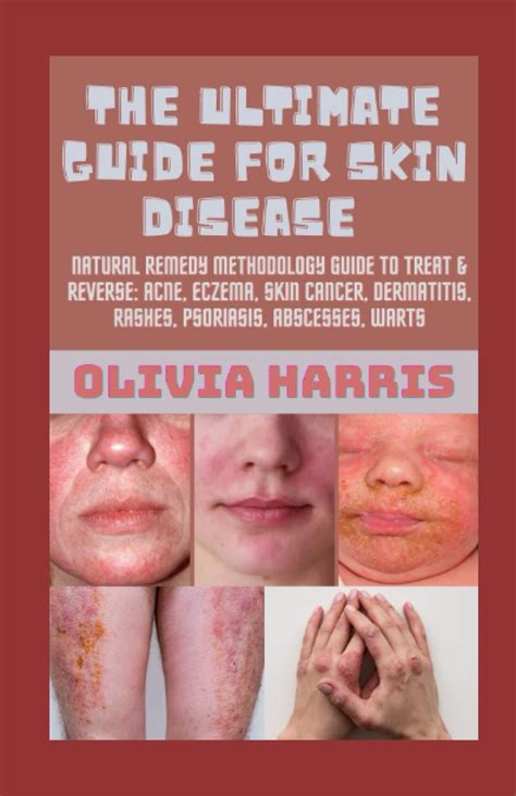 Buy The Ultimate Guide For Skin Disease Natural Remedy Methodology