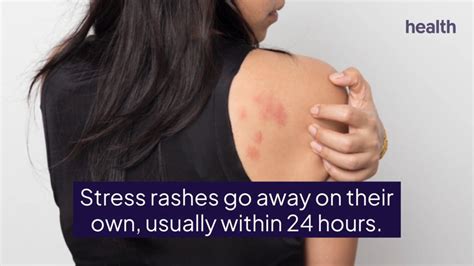 Stress Rashes And Stress Hives—heres What To Know