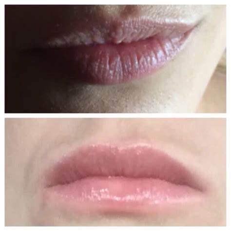 Before And After Lip Fillers Cosmetic Fillers Perfect Lips