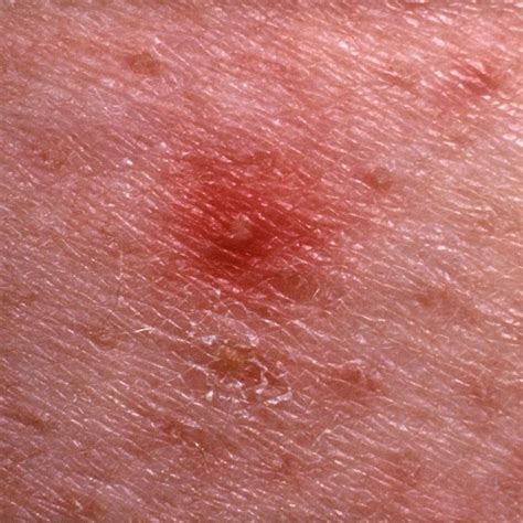 12 Bumps On Your Skin That Are Totally NormalAnd You Shouldn T Pop
