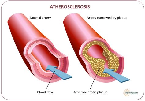 Treatment Of Atherosclerosis Nanoparticles Based Therapies Power Of