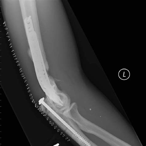A Anteroposterior Radiograph Showing A Comminuted Ulnar Shaft Fracture
