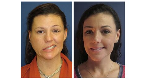 Facial Nerve Paralysis Before And After Gallery Mount Sinai New York