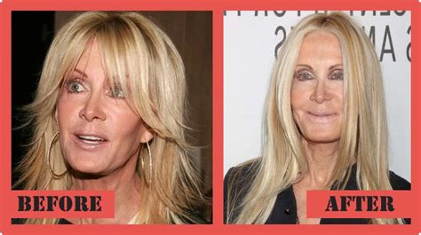 Joan Van Arks Before And After Plastic Surgery Photos Top Celebrity Hot Sex Picture