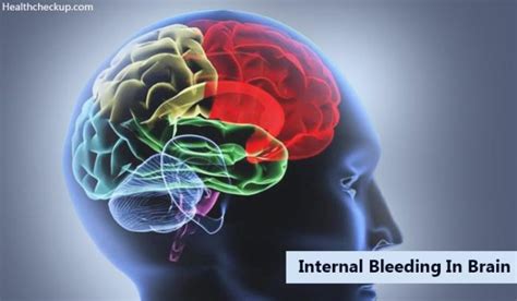 Internal Bleeding In Brain Symptoms Causes Diagnosis Treatment