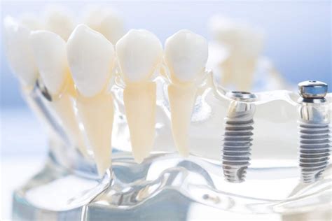 Lifespan Of Dental Implants How Long Do They Last Synergy