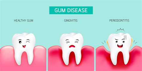 Gum Or Periodontal Disease Causes Symptoms Diagnosis