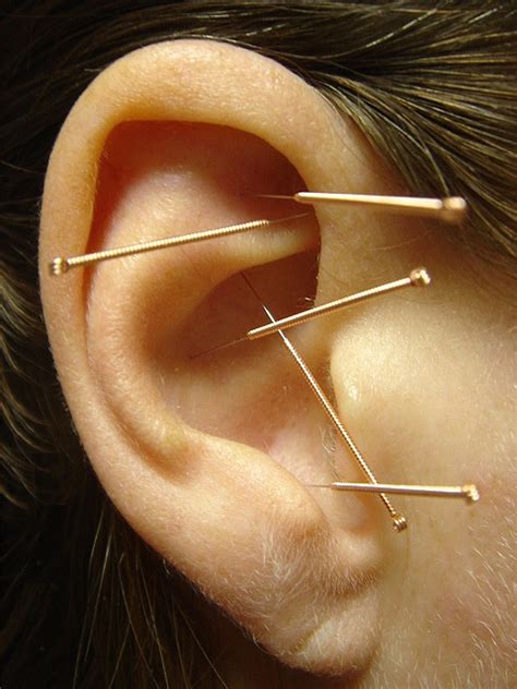 Ear Acupuncture Uk