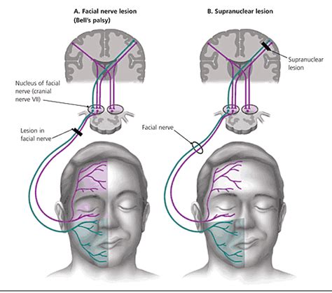 Resultado De Imagen De Lesion Corticobulbar Facial Nerve Nerve Palsy