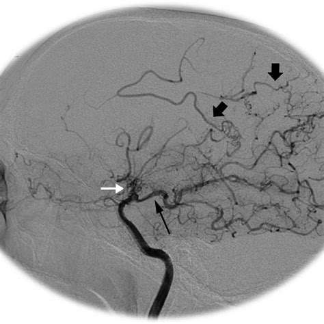 Right Internal Carotid Artery Injection Shows Distal Interior Carotid