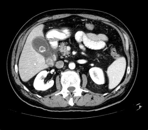 Acute Cholecystitis Ct Scan Wikidoc