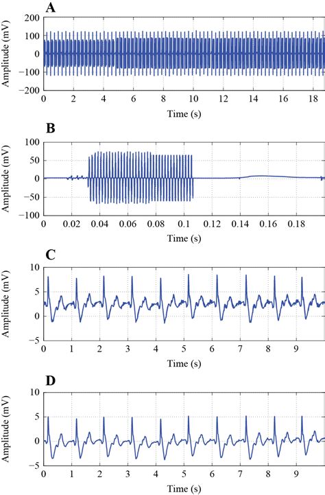 Reducing Of Gradient Induced Artifacts On The Ecg Signal During Mri