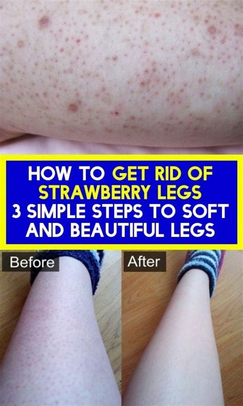 How To Get Rid Of The Strawberries Of Legs 3 Easy Steps In 2020