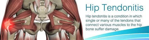This article serves as a reference outlining the various hip muscle groups based on function. Hip Tendonitis|Causes|Symptoms|Treatment|Exercise|Prevention