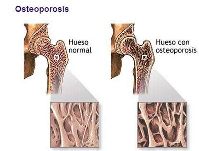 Enfermedades Del Esqueleto Humano Esqueleto Humano