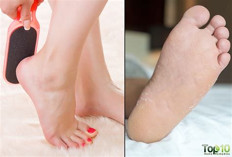 How To Get Rid Of Peeling Skin On Your Feet Top 10 Home Remedies