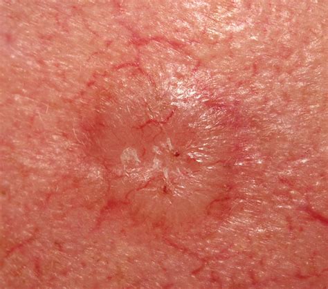 Basal Cell Carcinoma Surgeries For Skin Lesions Toronto Minor My Xxx Hot Girl