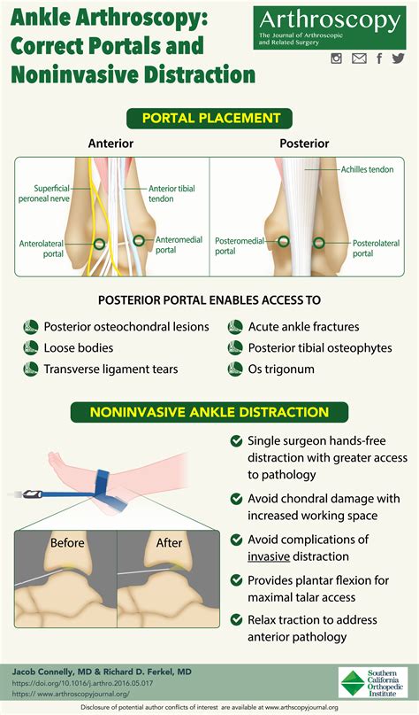 Ankle Arthroscopy Correct Portals And Noninvasive Distraction