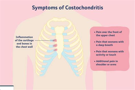Costochondritis Cuasesymptoms Diagnosis Treatment Physiotherapy